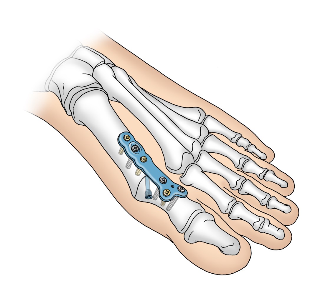 Hallux rigidus KlinikImpuls